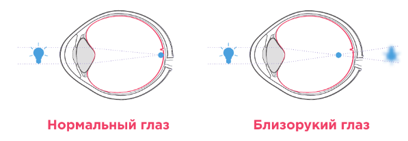 миопия.png миопия.png